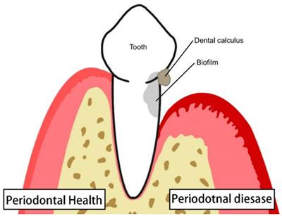 Relevant mechanisms of MAIT cells involved in the pathogenesis of periodontitis